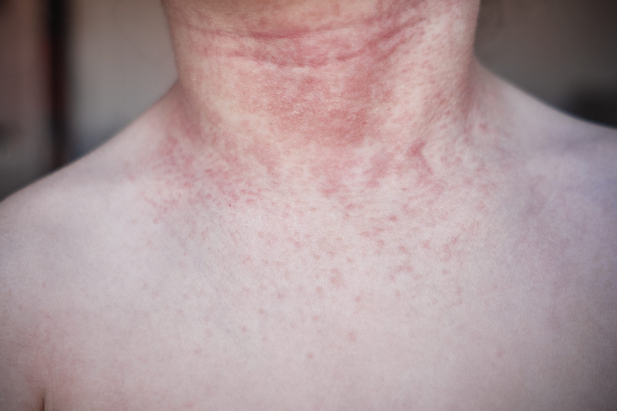 Close-up of a person&#x27;s neck with a visible red rash, potentially an internet-found unusual medical condition