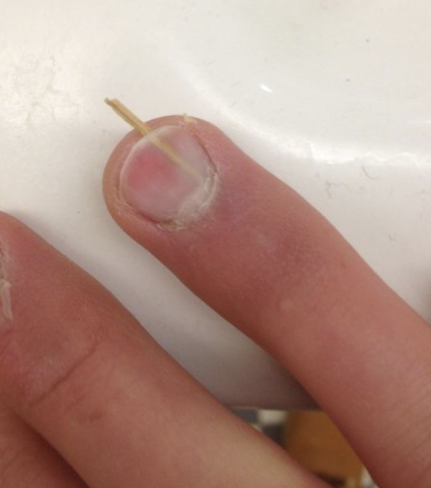 Close-up of a finger with a huge splinter extending under the nail and out of it