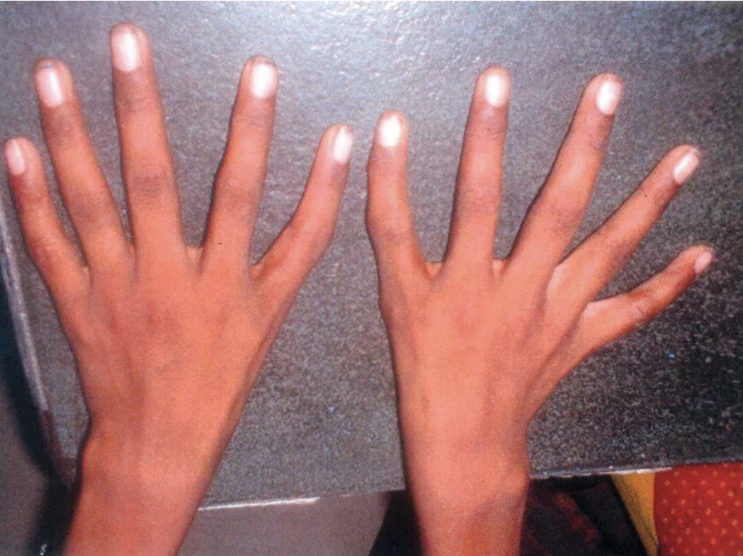 Two hands placed flat on a surface, with fingers spread apart, showing elongated, slim thumbs