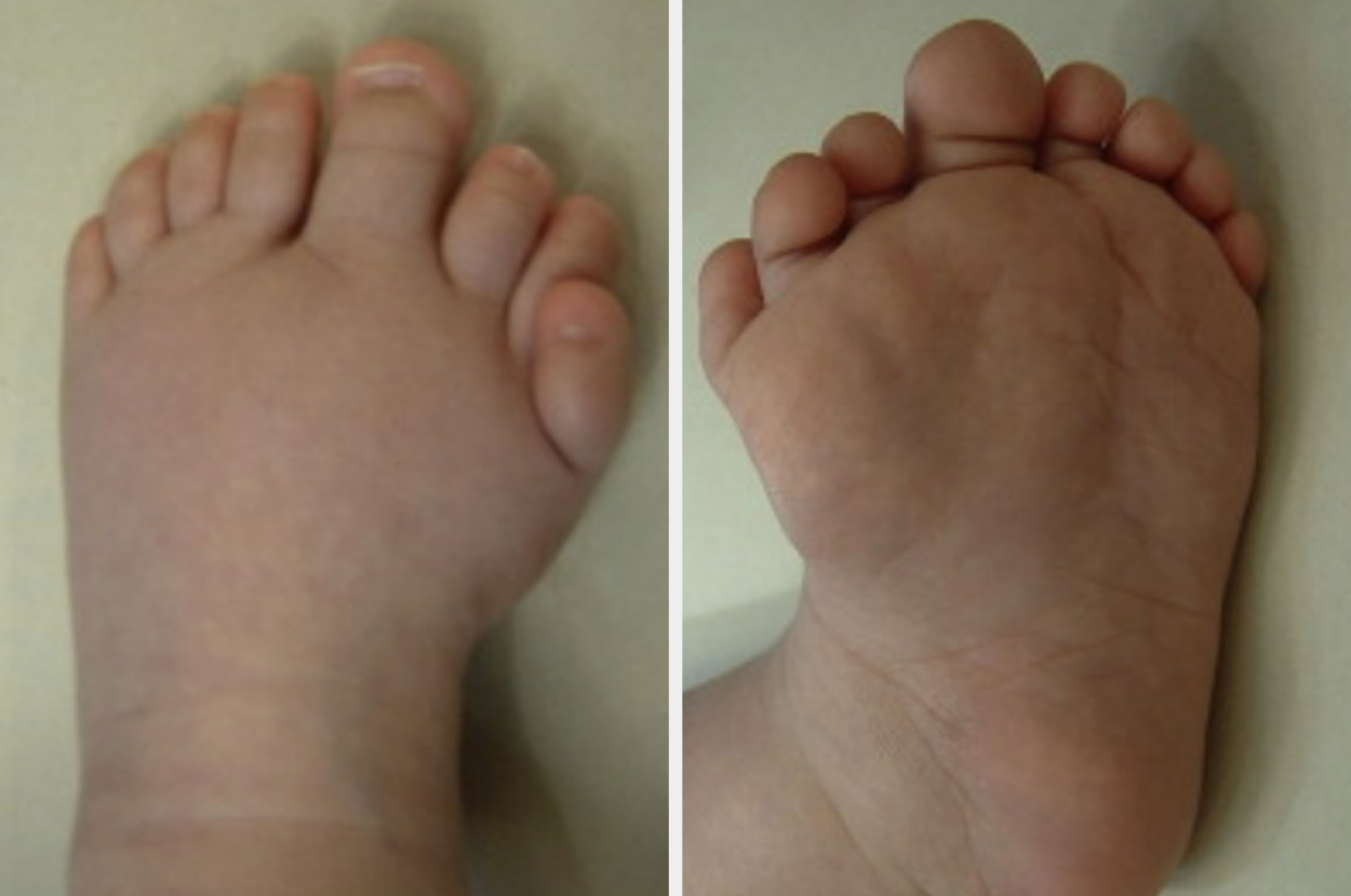 Two images showing the top and bottom of an infant foot with eight tees and one large toe in the center