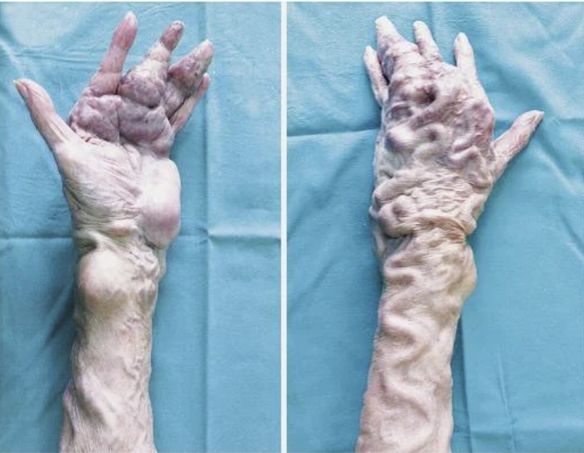 Two hands and arms covered with thickened, bulging blood vessels