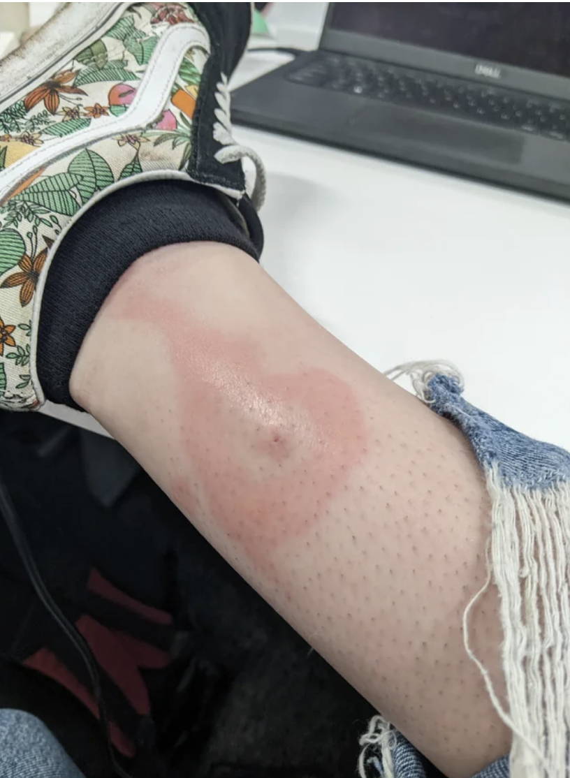 Person with a red, irregular skin reaction on their lower arm with what looks like an insect bite in the middle
