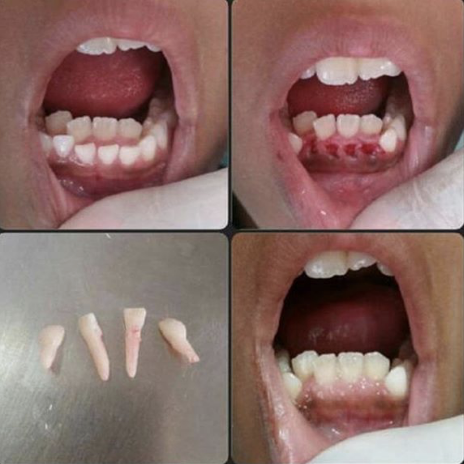 Four images of a mouth with two rows of teeth on the bottom, and after four have been removed