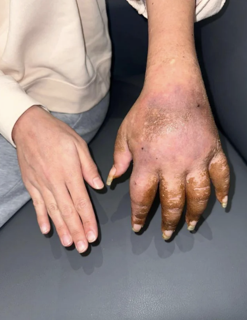 Two hands on a flat surface showing one of a normal size and the other with blotchy skin and extremely thickened fingers