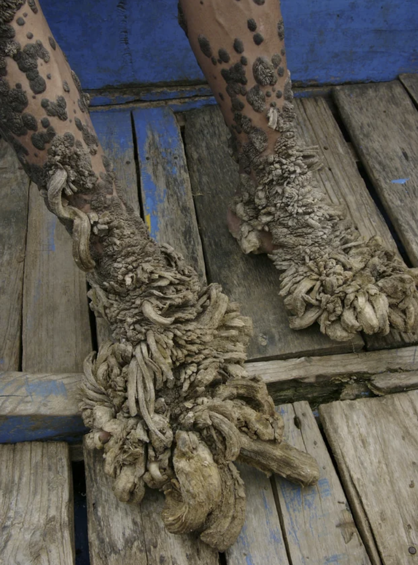 Feet with advanced barnacle growths standing on a blue wooden surface