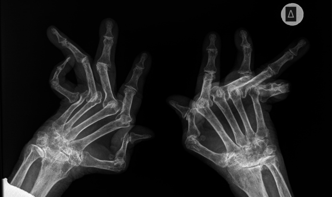 X-ray image of two hands showing the finger bones/phalanges bent at unnatural angles