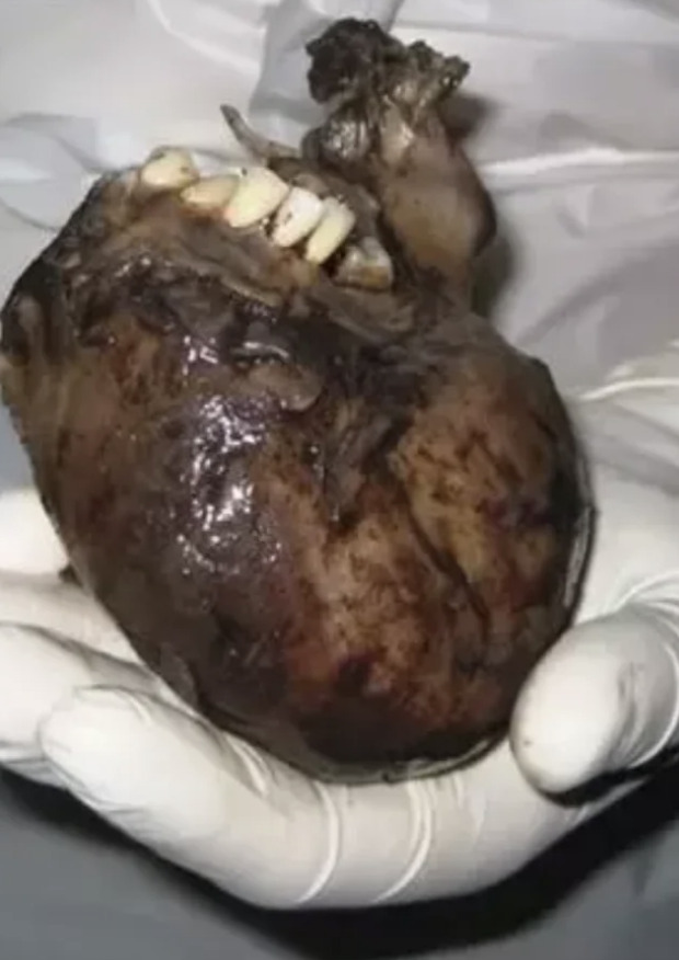 Large, mottled tumor resembling a face with teeth, resting on a gloved hand