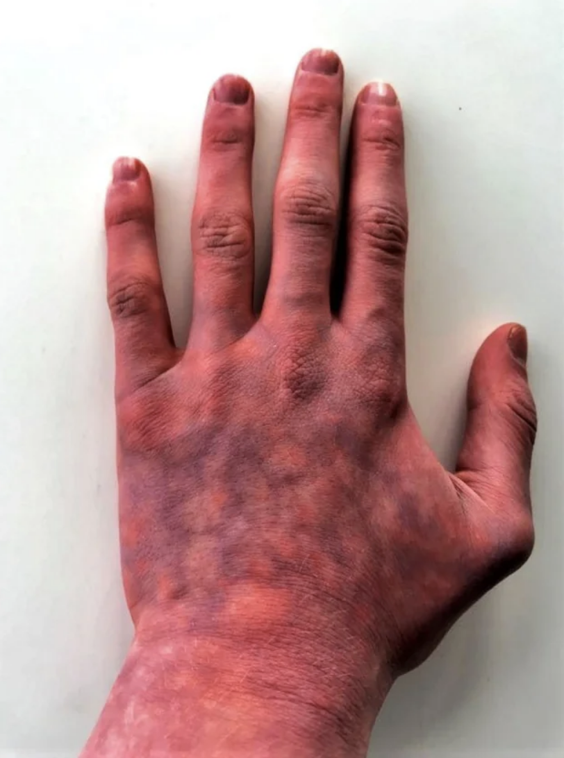 Close-up of a hand showing a speckled, mottled skin inflammation