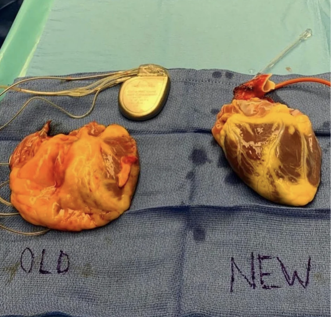 Two hearts, the old one, with lots of fatty areas, on the left and the replacement on the right, displayed on a surgical cloth