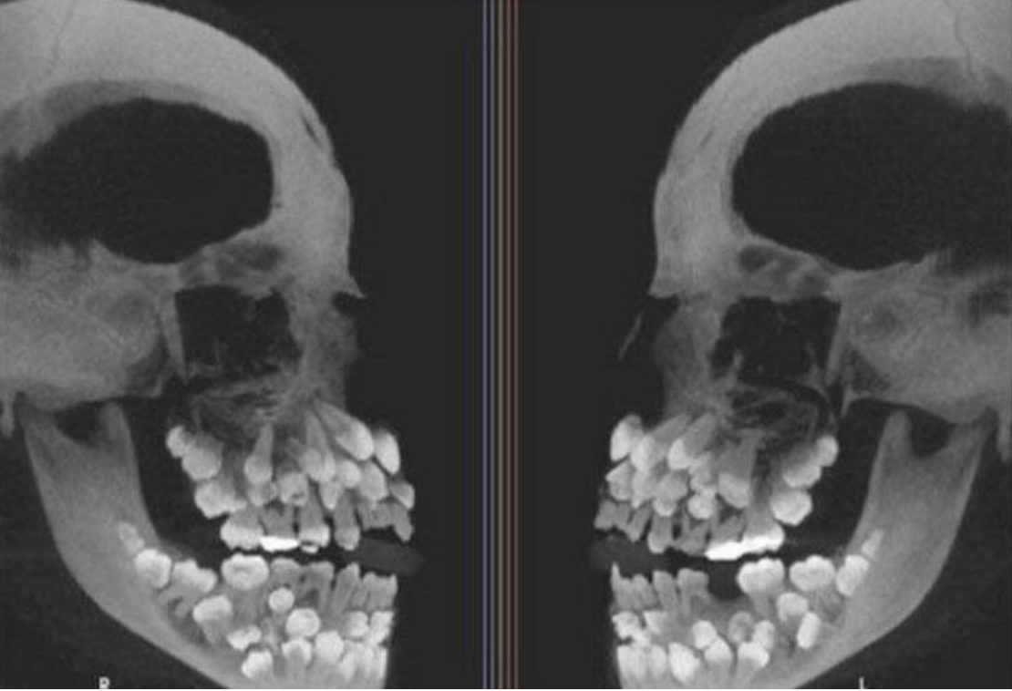 Side-by-side X-ray images of a human skull showing dozens and dozens of teeth  in many rows and jaw structure