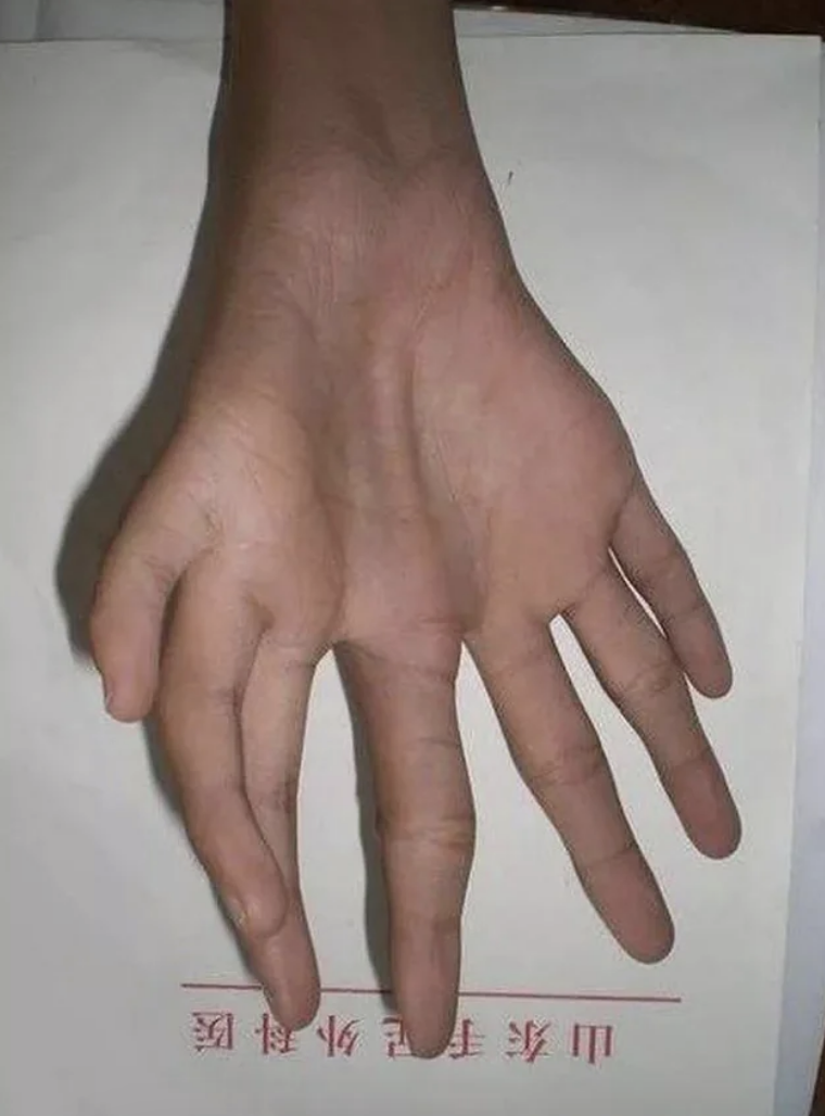 Hand with seven fingers