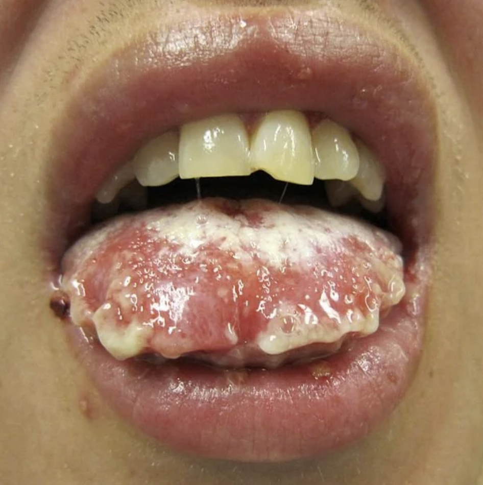 Close-up of a person&#x27;s mouth showing a tongue with pale, dripping growths