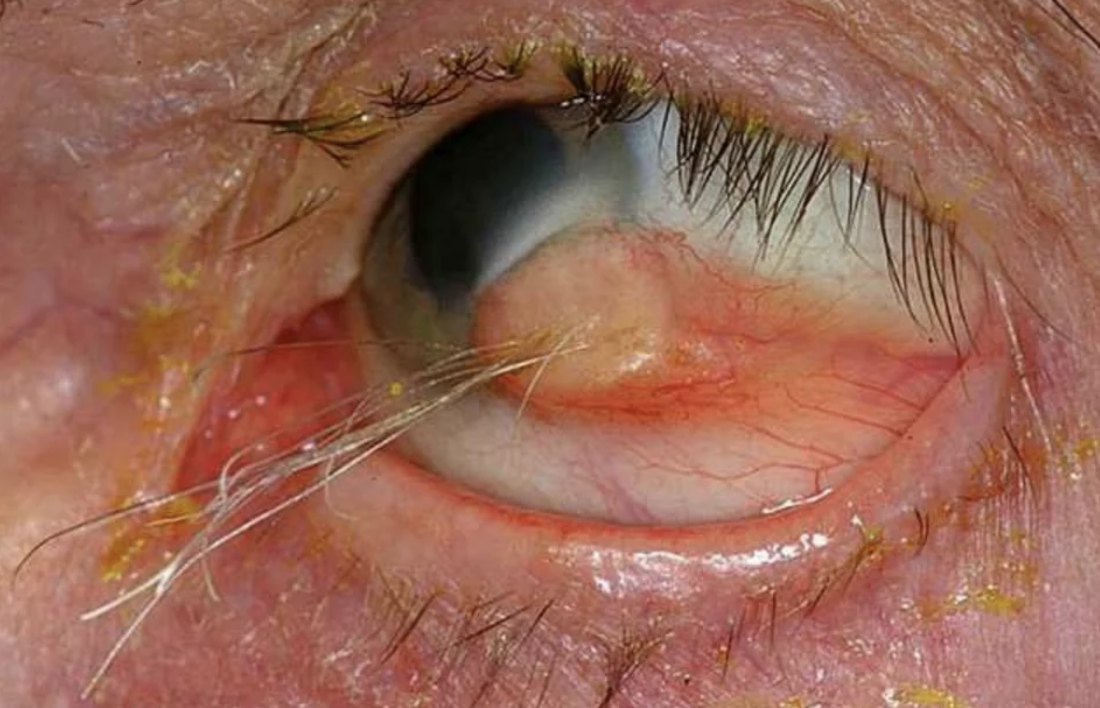 Close-up of a reddened eye with thin strands of hair emerging from it