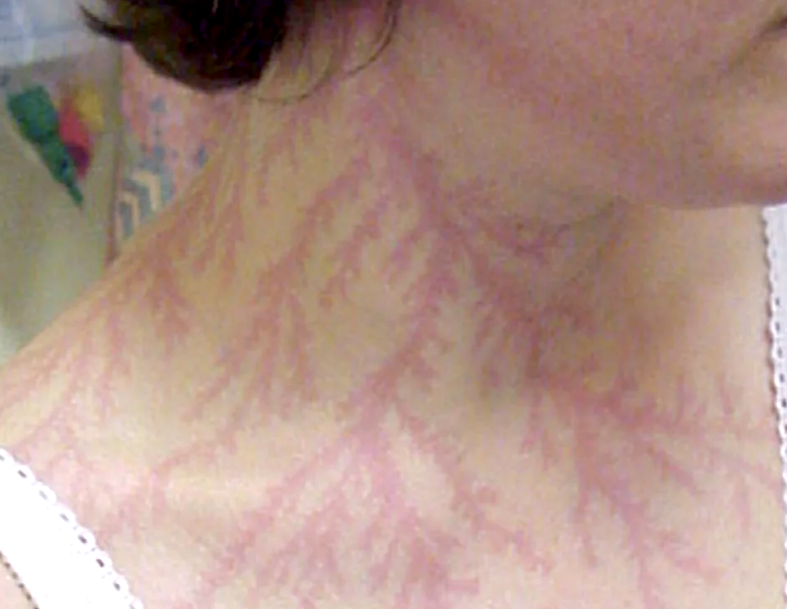 Close-up of a person&#x27;s neck showing a red rash pattern that looks like tree branches, aka Lichtenberg figures