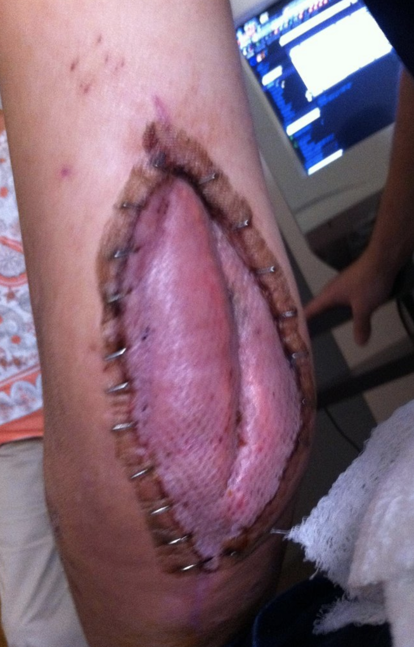 Close-up of a person&#x27;s limb showing staples and a huge, open incision