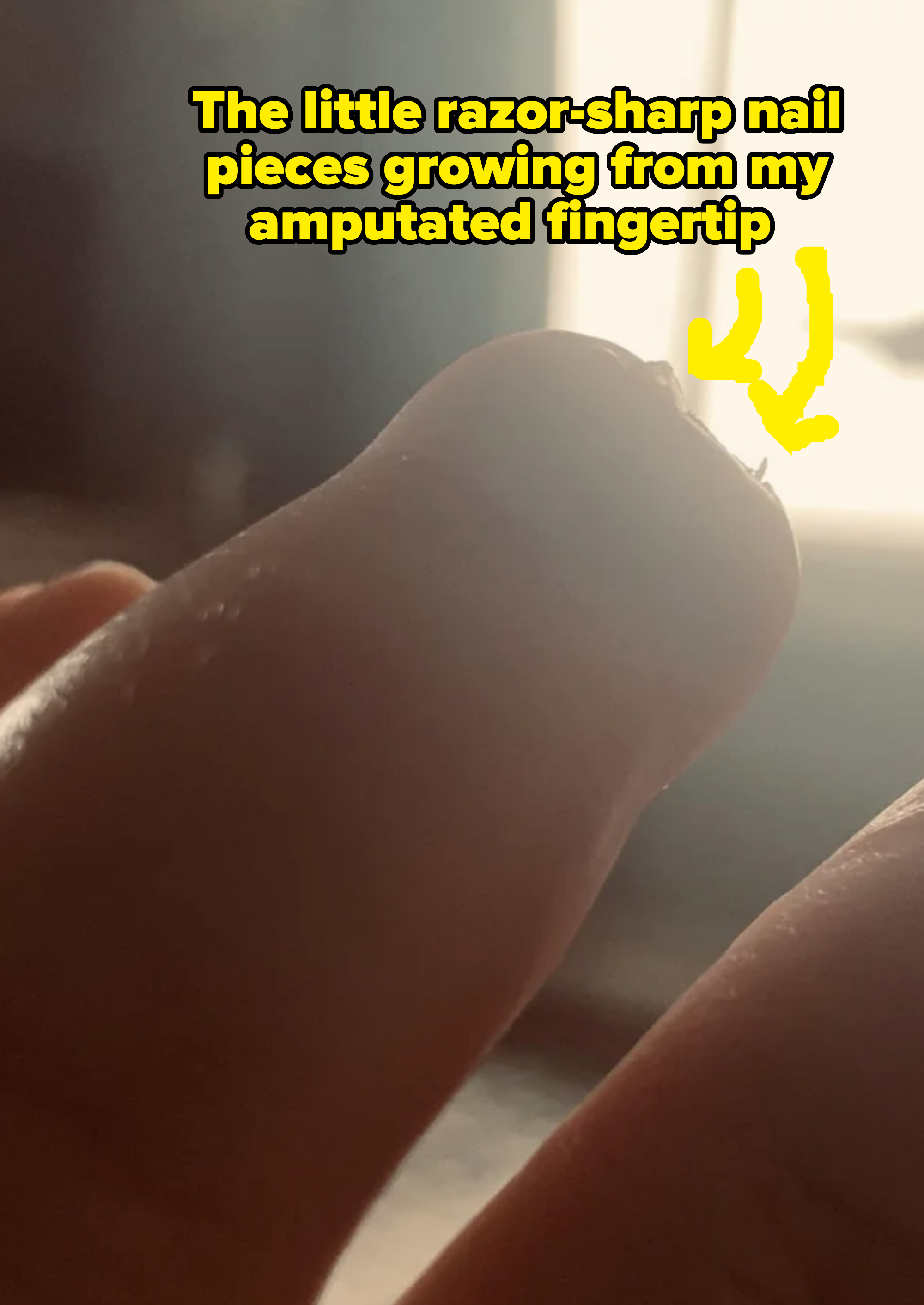 Close-up of a finger with no nail, but a tiny, needlelike tip growing on top of it, backlit by a light source