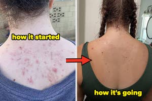 The reviewer with back acne before using acne body. That same reviewer with a clear back after using body wash