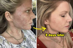 a reviewer before and after using vanicream on their face for 3 days, showing improved texture and skin tone