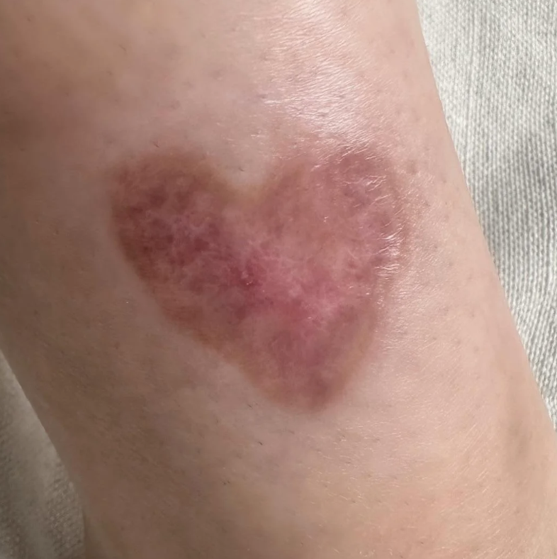 Bruise on skin shaped like a heart