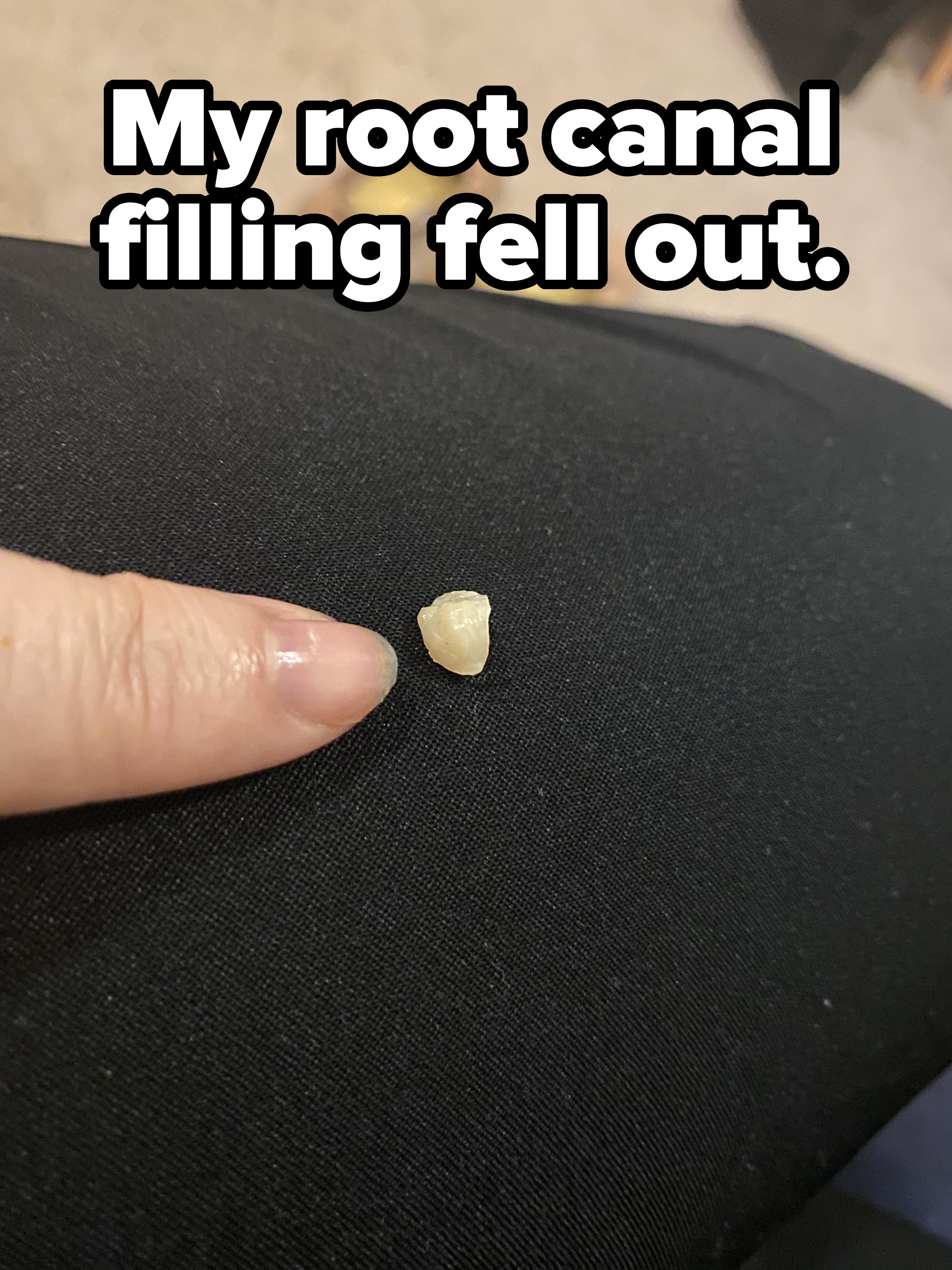 Person showing a piece of a tooth on a surface, with caption &quot;My root canal filling fell out&quot;