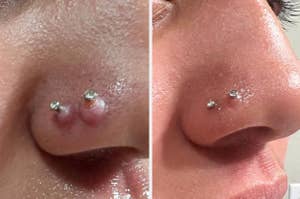 reviewer with two nose piercings that both have keloids; after of the same reviewer with the keloids completely gone