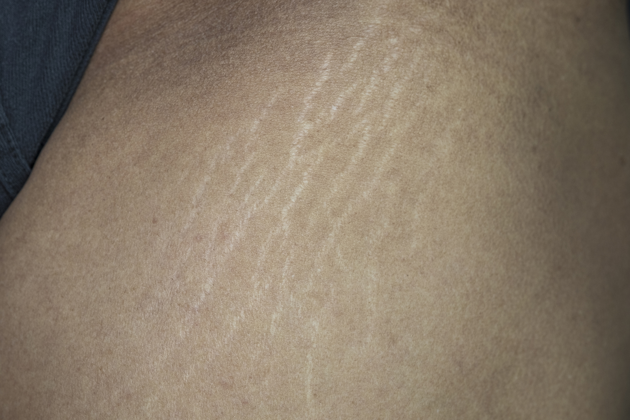 Close-up of skin with stretch marks