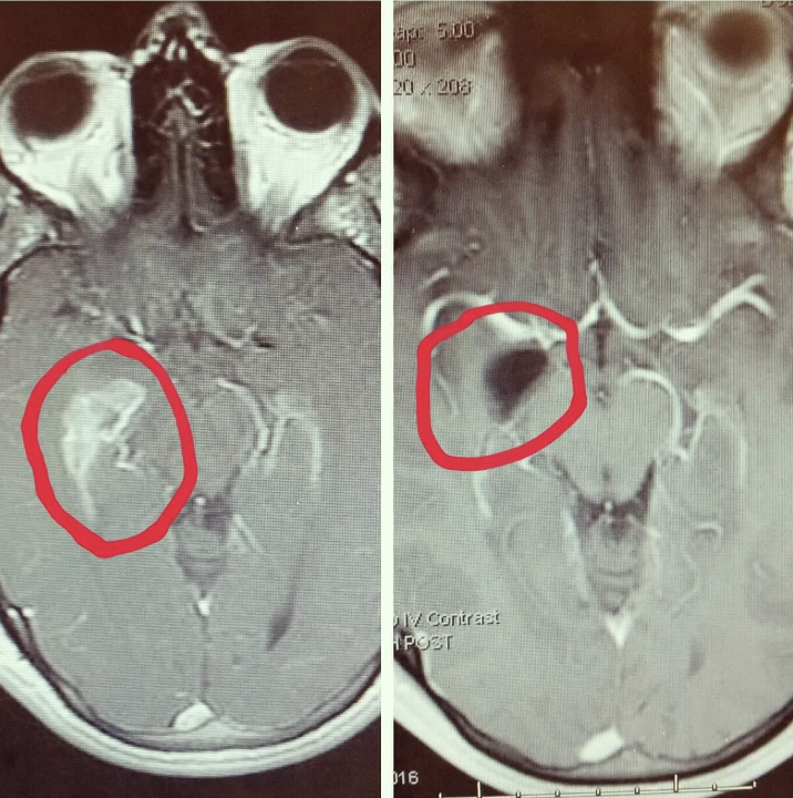 Two side-by-side MRI brain scans with red circles highlighting areas of interest