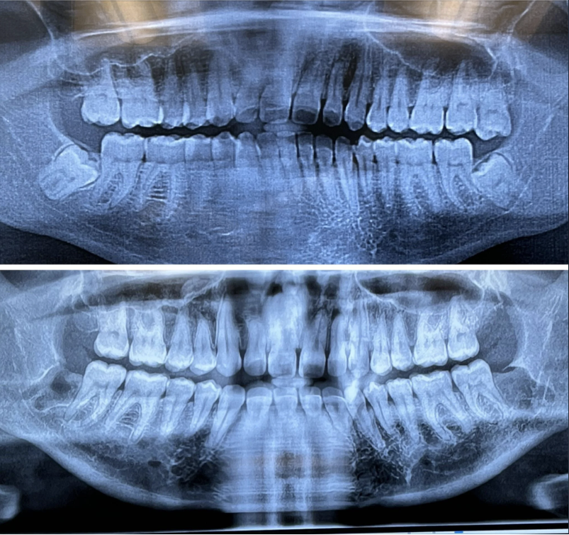 Two dental X-rays showing upper and lower teeth, used in discussing children&#x27;s dental health