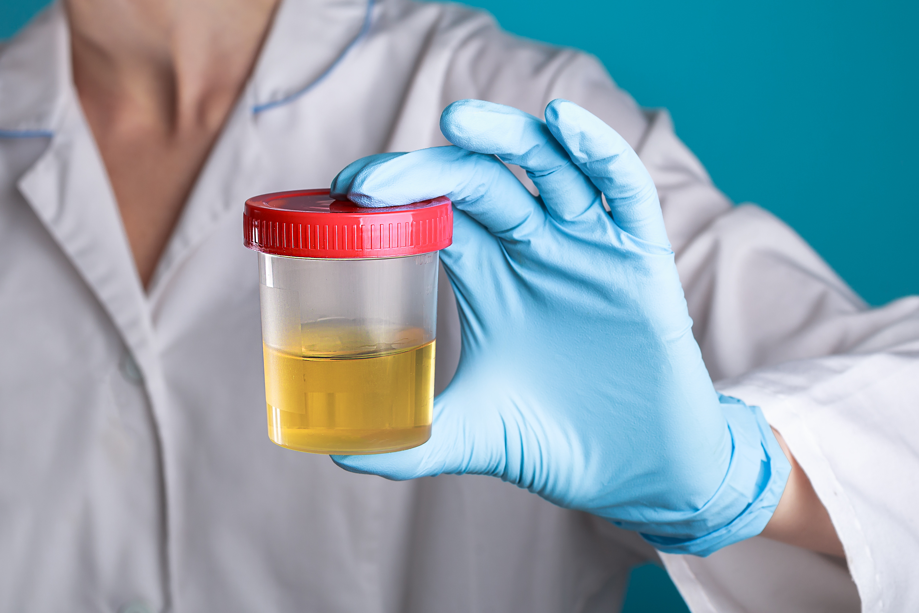 Lab technician in gloves holding a container of urine for analysis