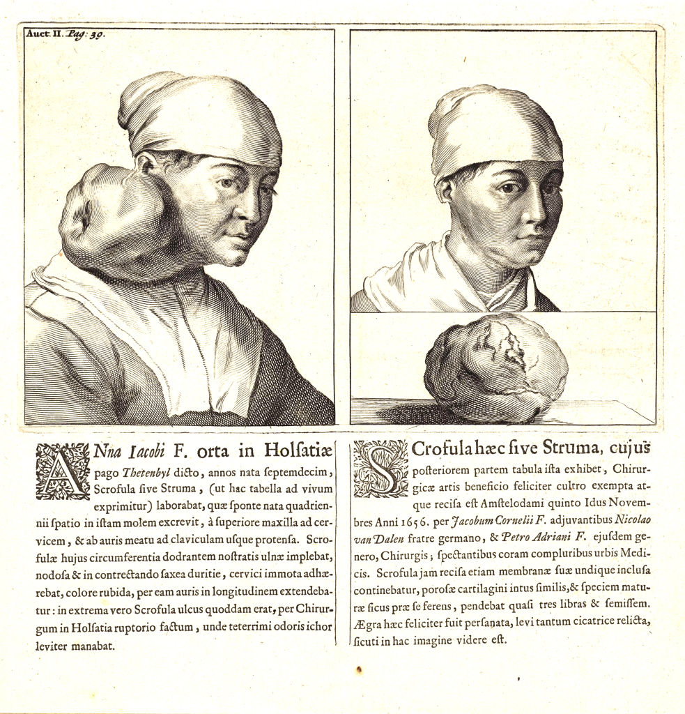 Illustration of two people with medical facial swellings from a historical medical text