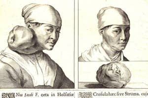 Historical medical illustration of two individuals with goiters