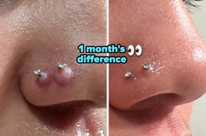 reviewer photo of double nostril piercing with keloids on them / after photo of same reviewer after using piercing bump solution with keloids now gone