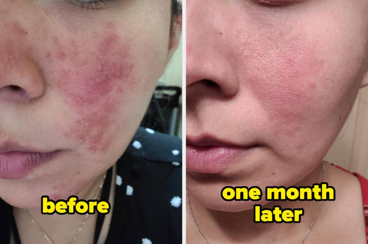 Side-by-side comparison of a person's face before and after skincare treatment, with clearer skin in the 'one month later' photo