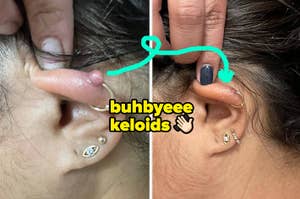 a reviewer's ear with a keloid and after without "buhbye keloids"