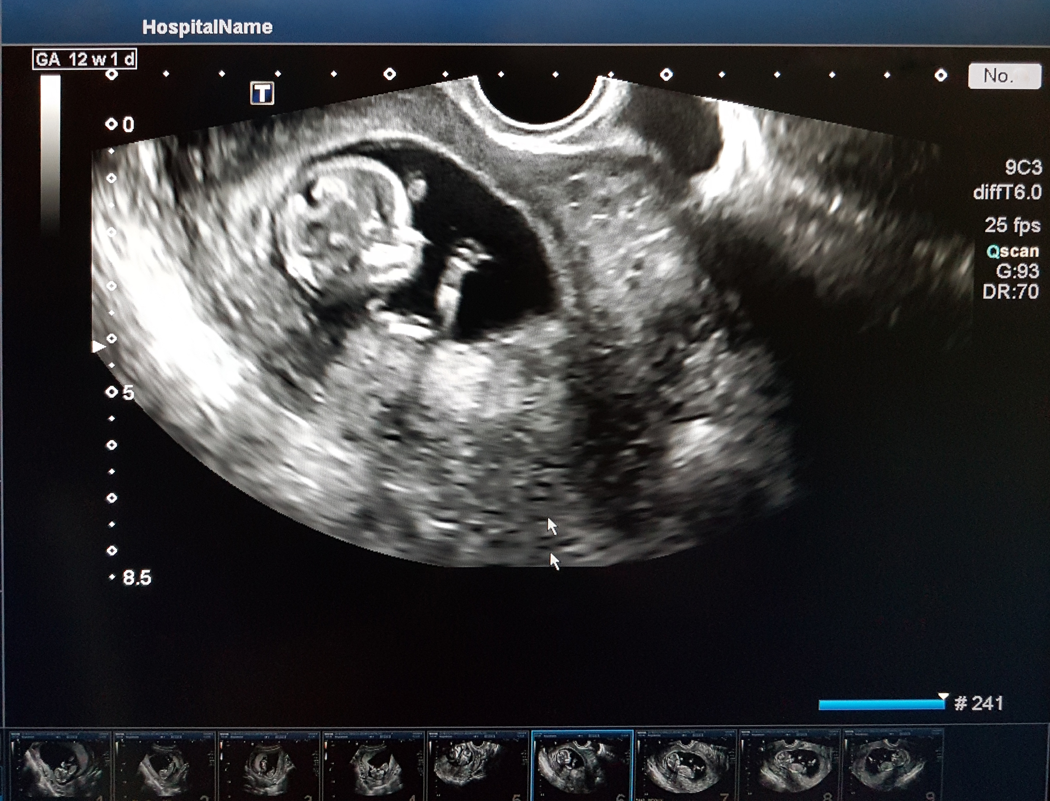 Ultrasound image showing a fetus at 12 weeks gestation