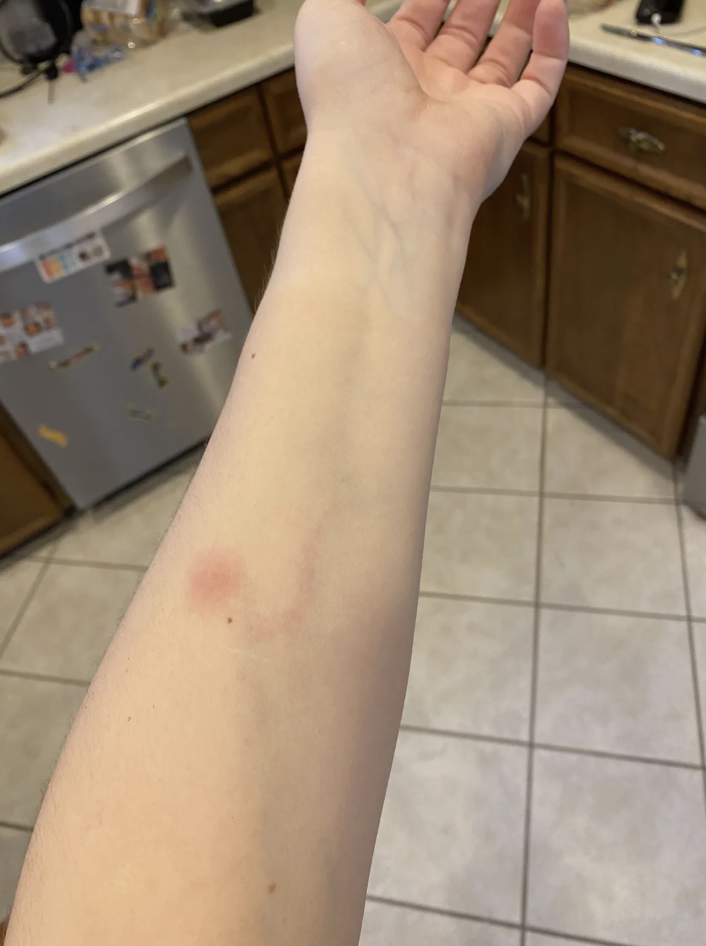 Person&#x27;s arm with a small bruise, shown against a kitchen background