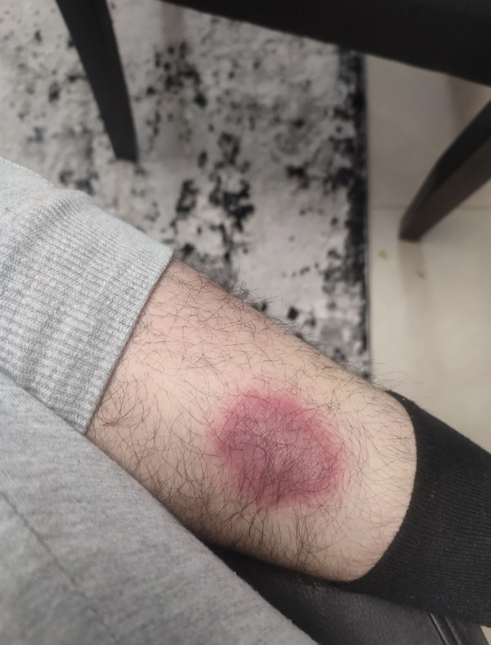 Person&#x27;s forearm with a noticeable red rash or skin irritation visible