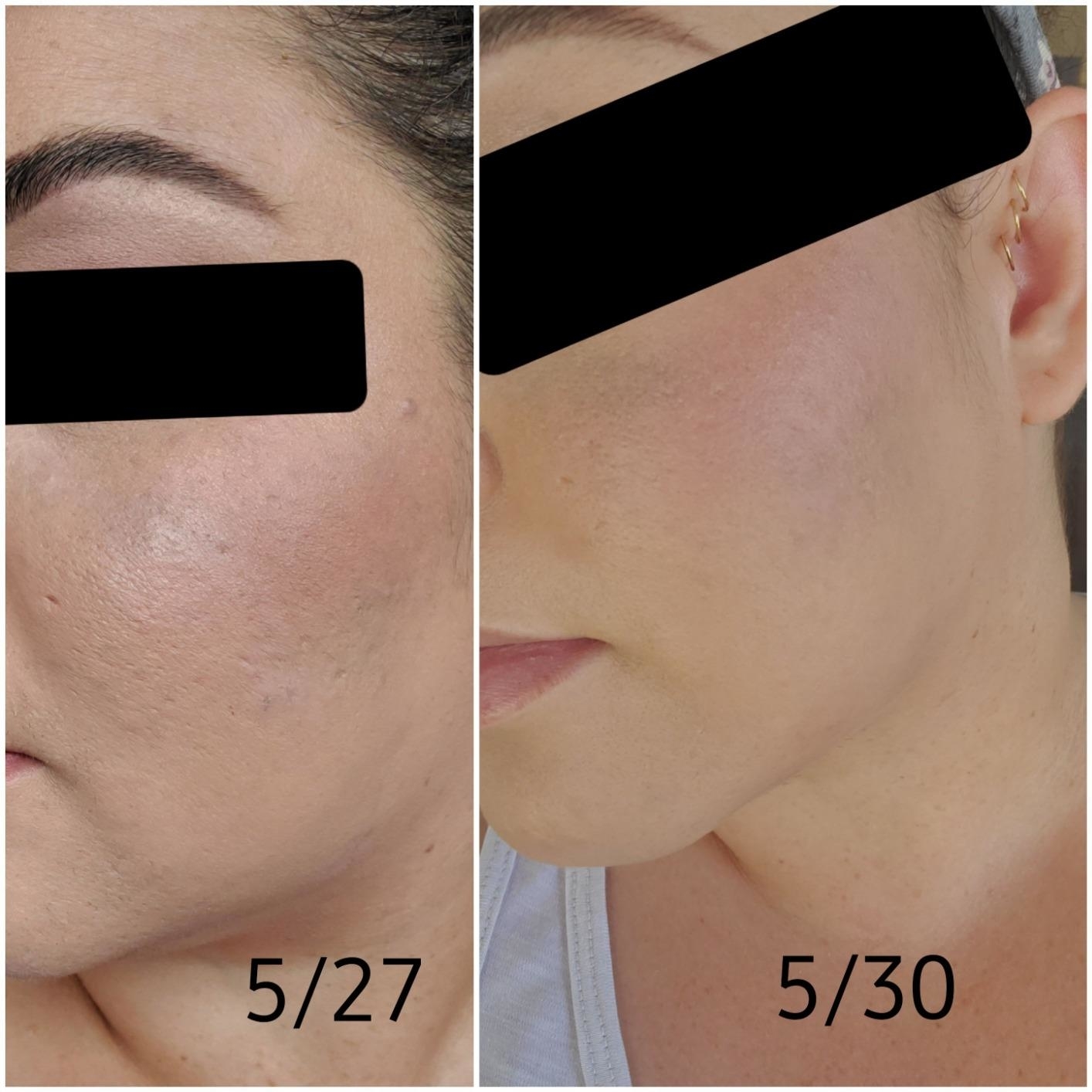 Before and after comparison of a person&#x27;s skin treatment, results visible, dated 5/27 and 5/30 showing visibly reduced pores and less blackheads
