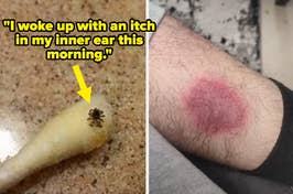 A spider on a cotton swab and a person's leg with a circular rash