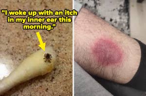 A spider on a cotton swab and a person's leg with a circular rash