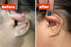 a before and after for a keloid solution