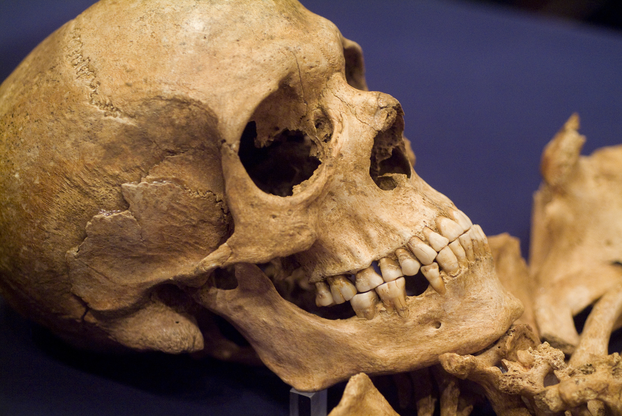 Close-up of a human skull showing teeth, possibly from an archeological find, displayed for study or exhibit