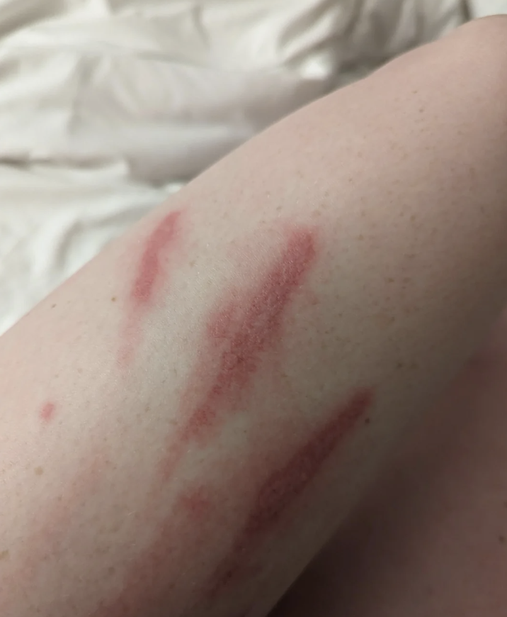 Arm with red scratch marks, possibly from a pet or a minor injury