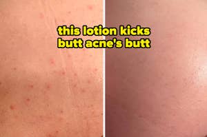 Before-and-after skin comparison showing improvement from using a lotion for acne