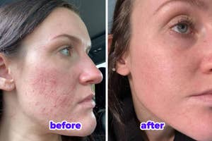Before and after comparison of a person's facial skin treatment results