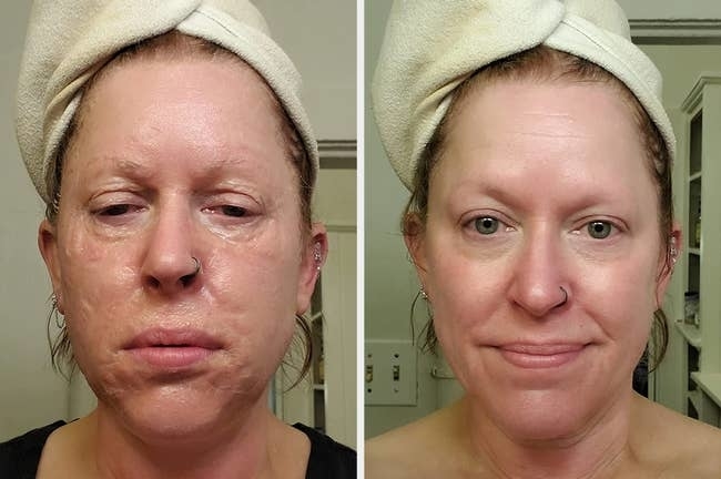 Person before and after skin care treatment, towel on head, subtle changes visible in skin texture