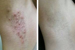 Two side-by-side images of a person's skin before and after treatment for a skin condition
