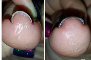 before and after showing a reviewer's toenail now straight