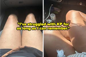Close-up of person's legs highlighting skin condition, with a quote about struggling with KP (keratosis pilaris)