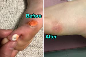 reviewer with two corns on foot then reviewer's foot healed